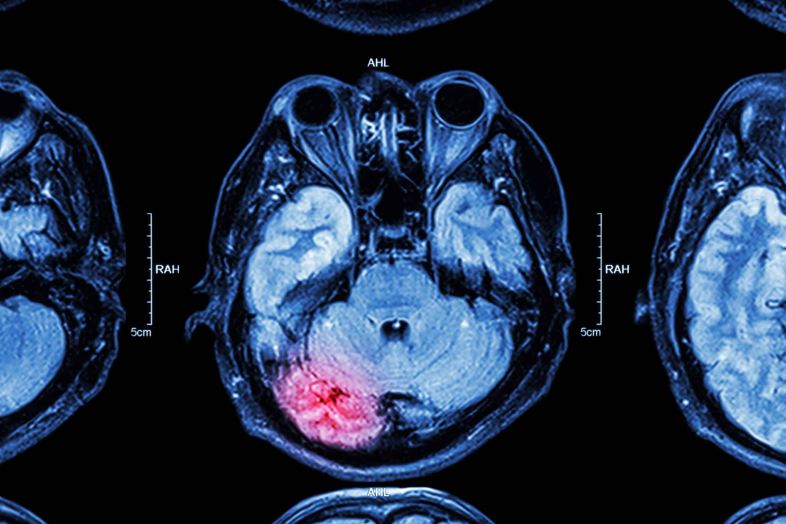 Long Term Consequences Of Brain Injury